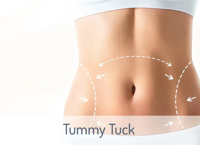 Galería de Abdominoplastia